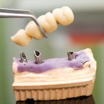 Types of bridges, which ones to choose?