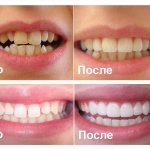 Виниры до и после
