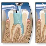 витальная ампутация пульпы у детей