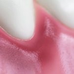 inflammation of the gums due to gingivitis