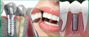 Possible complications after single-phase dental implantation