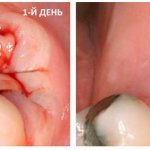 Заживление десны