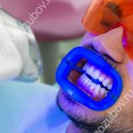 Zoom - teeth whitening