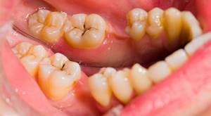 Зубной Кариес Лечение