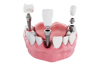 Зубные коронки - Стоматология Линия Улыбки