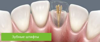 dental pins