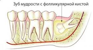 Зубы мудрости: удалить нельзя оставить. Интервью со стоматологом-хирургом