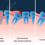 зубы мудрости